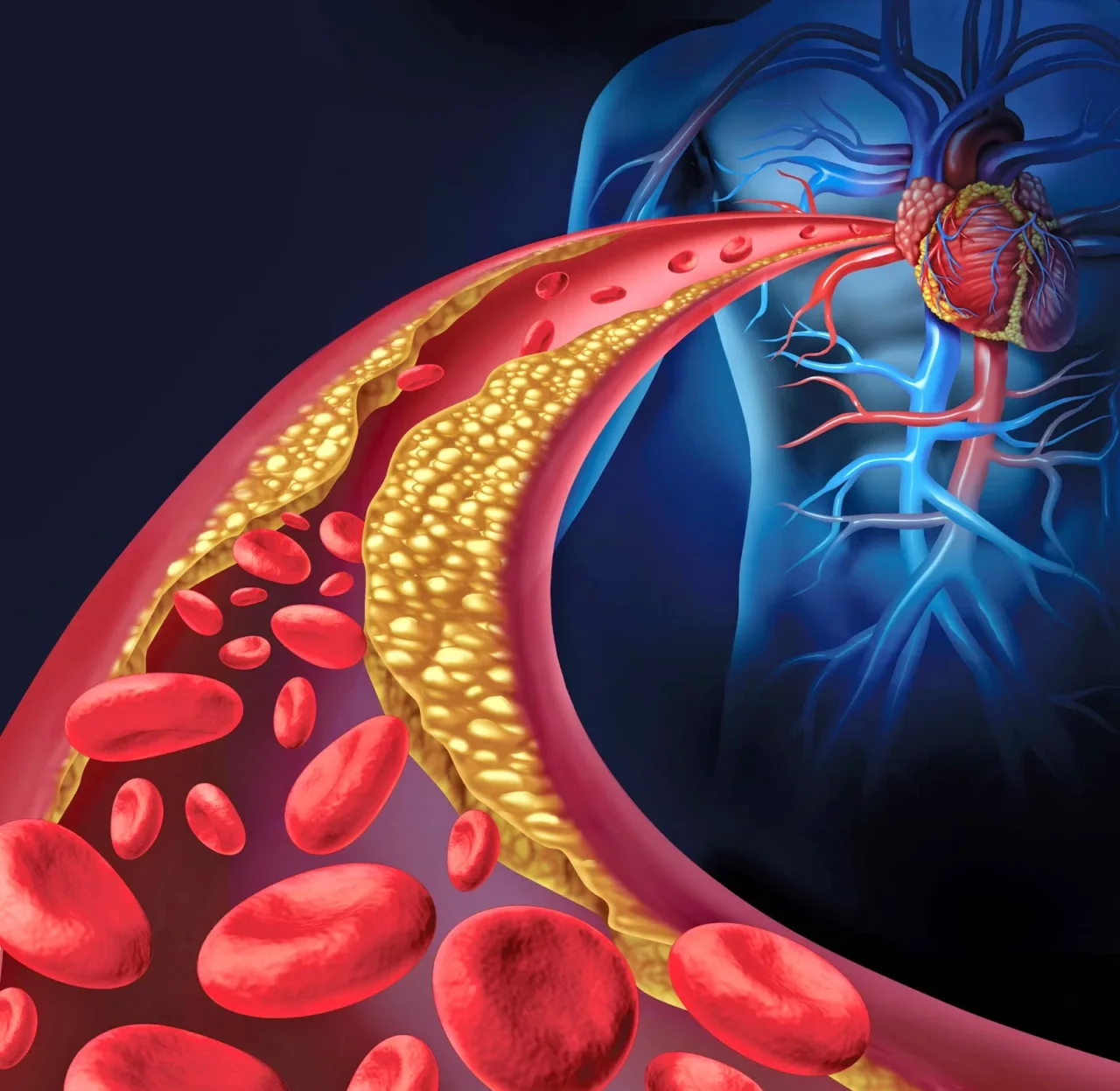 Qual è il tuo rischio di infarto? Ecco le tabelle ufficiali per valutarlo e come leggerle